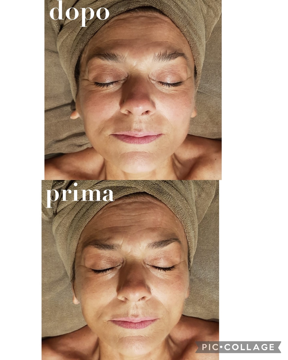 Prima e dopo di un trattamento viso, esempio 2