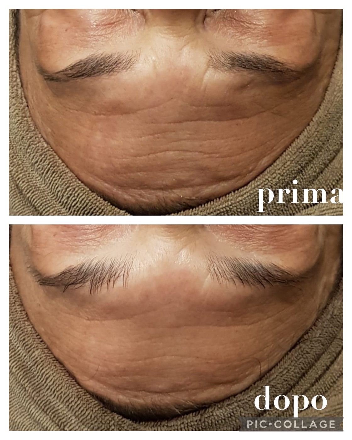Prima e dopo di un trattamento viso, esempio 6